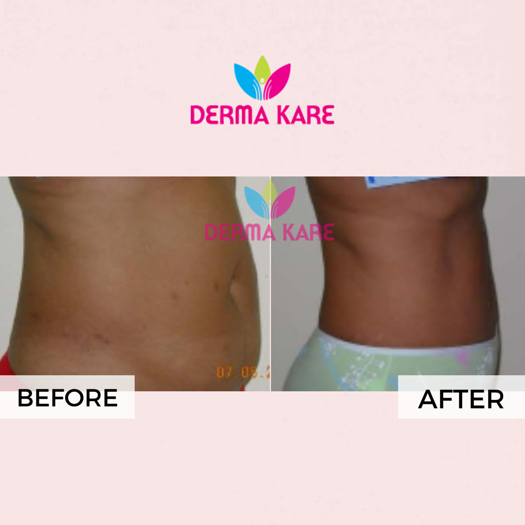 Mesotherapy - Derma kare Skin & Body Centre